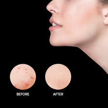 Load image into Gallery viewer, Acne Repairing Treatment