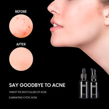 Load image into Gallery viewer, Fragile Acne Skin Therapy Duo